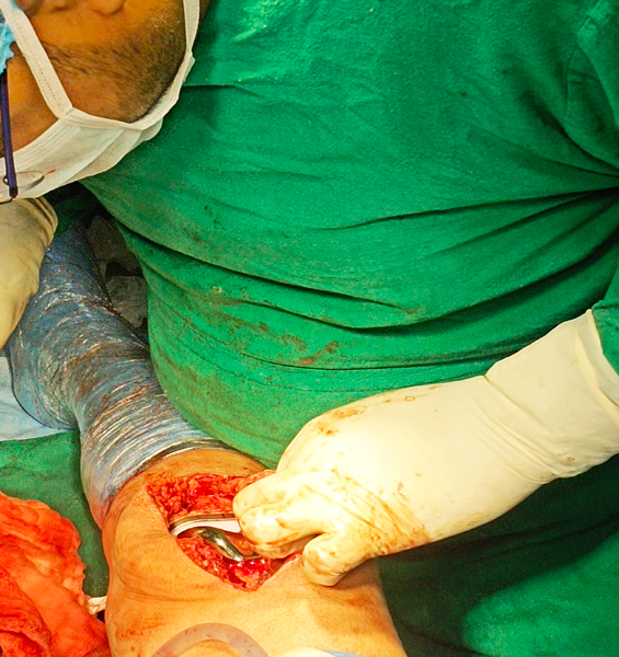 Dr. Ankit Agrawal Best Orthopaedic Surgeon, Best Orthopaedic Surgeon in Mathura, best doctor Dr. Ankit Agrawal in Mathura,orthopedic doctor in mathura, hip replacement in mathura, best doctor in mathura , Best Orthopaedic Surgeon in Mathura, knee replacement in mathura, best doctor Dr. Ankit Agrawal in Mathura 