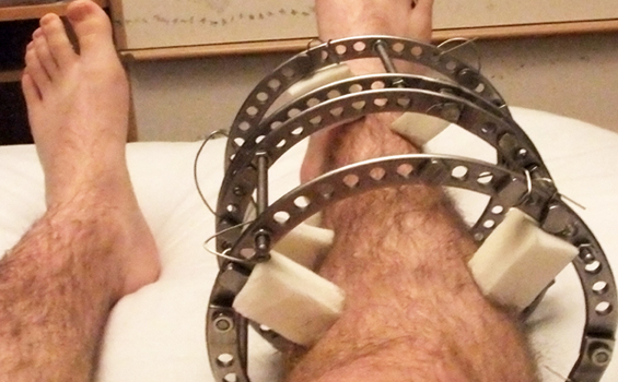 Dr. Ankit Agrawal Best Orthopaedic Surgeon, Best Orthopaedic Surgeon in Mathura, best doctor Dr. Ankit Agrawal in Mathura,orthopedic doctor in mathura, hip replacement in mathura, best doctor in mathura , Best Orthopaedic Surgeon in Mathura, knee replacement in mathura, best doctor Dr. Ankit Agrawal in Mathura